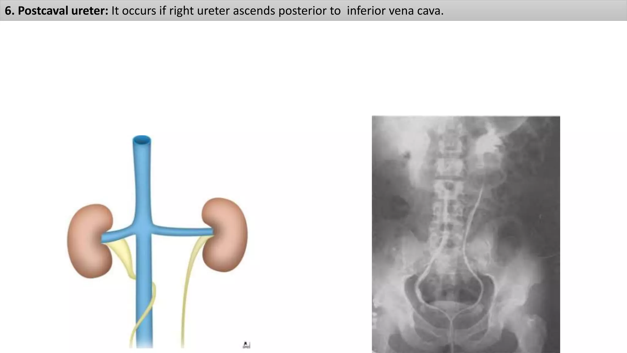 6. Postcaval ureter: It occurs if right ureter ascends posterior to inferior vena cava.
 