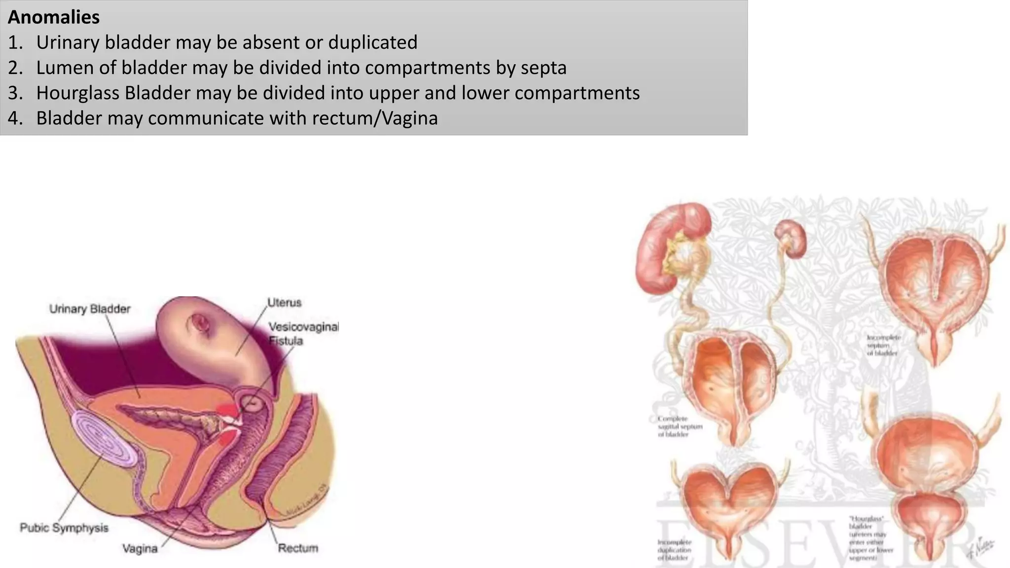 Anomalies
1. Urinary bladder may be absent or duplicated
2. Lumen of bladder may be divided into compartments by septa
3. Hourglass Bladder may be divided into upper and lower compartments
4. Bladder may communicate with rectum/Vagina
 
