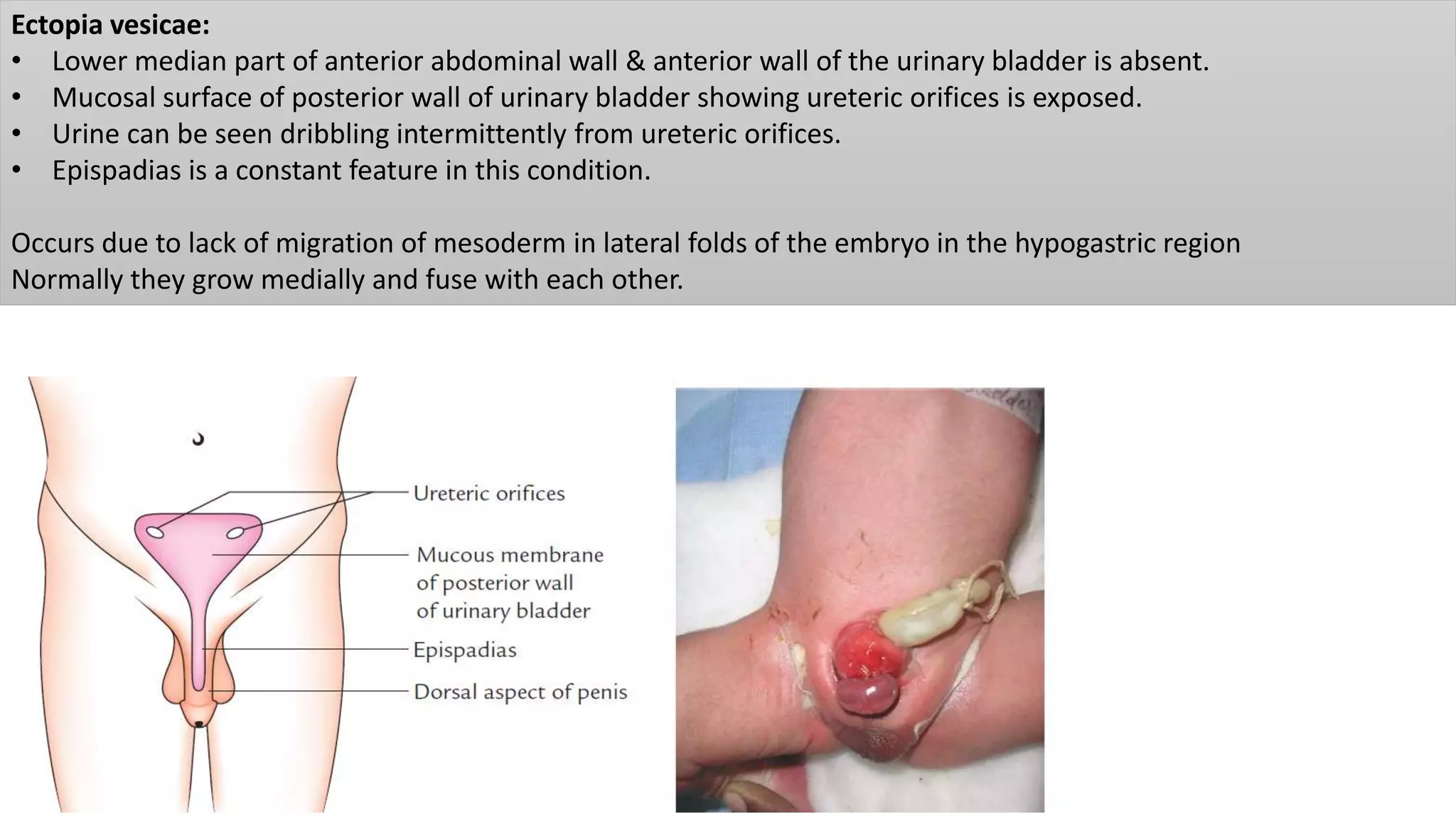 Ectopia vesicae:
• Lower median part of anterior abdominal wall & anterior wall of the urinary bladder is absent.
• Mucosal surface of posterior wall of urinary bladder showing ureteric orifices is exposed.
• Urine can be seen dribbling intermittently from ureteric orifices.
• Epispadias is a constant feature in this condition.
Occurs due to lack of migration of mesoderm in lateral folds of the embryo in the hypogastric region
Normally they grow medially and fuse with each other.
 