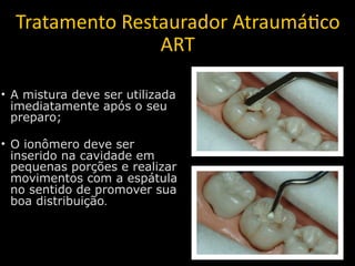 Tratamento Restaurador Atraumá2co 
               ART

                   Uma pequena camada de
                   vaselin...