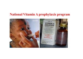 National Vitamin A prophylaxis program
 