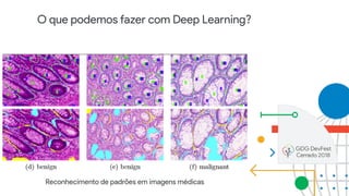 O que podemos fazer com Deep Learning?
Reconhecimento de padrões em imagens médicas
 