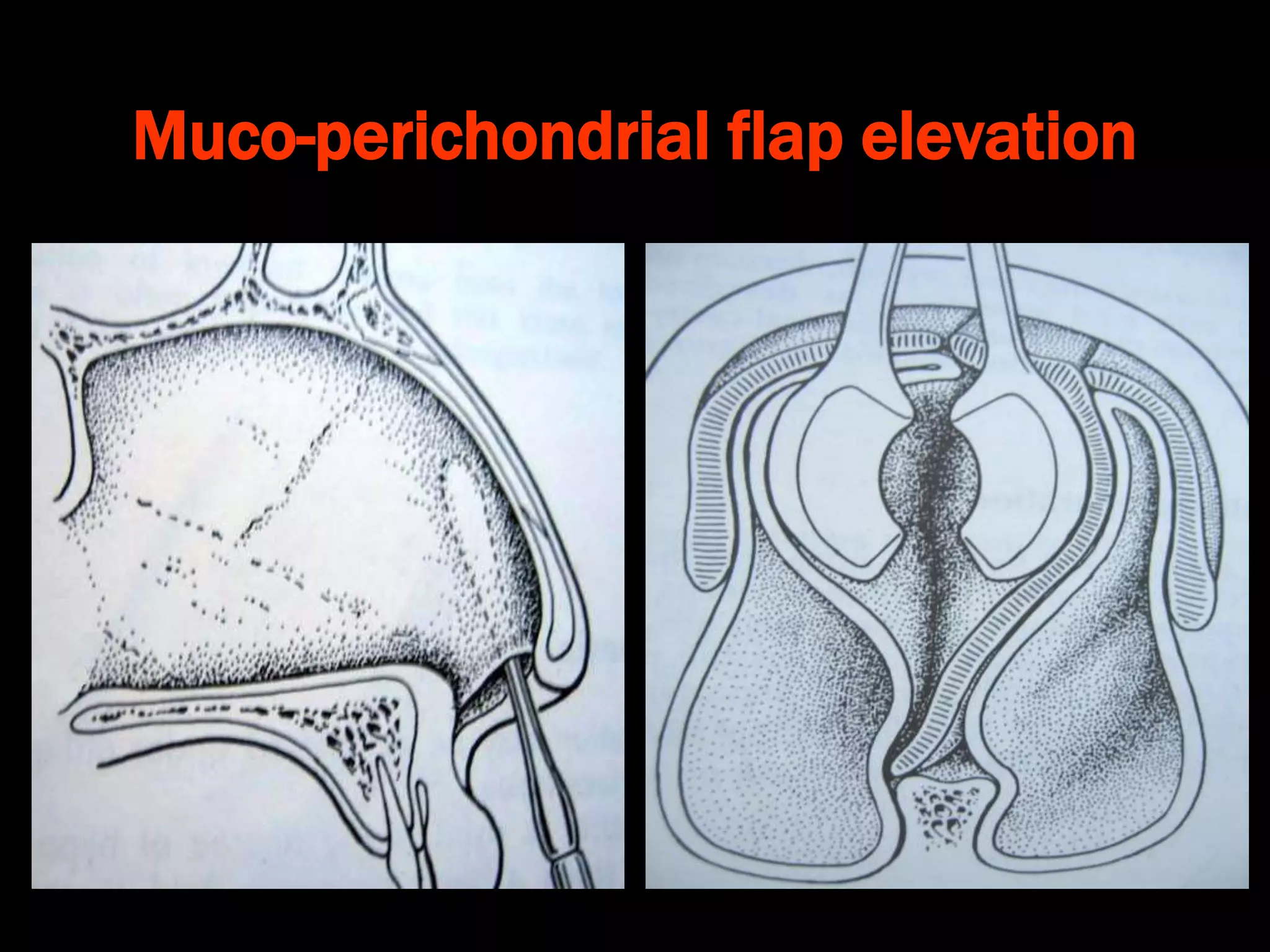 Deviated Sept Deviated nasal septum and other septal conditions | PPT
