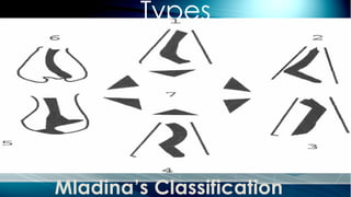 Types
Mladina’s Classification
 