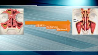 Packs
Splints
Suturing
Combined
 