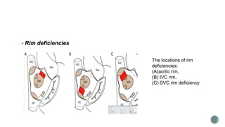 Peripheric Rim Location Cardiac catheterization DEVICE CLOSURE OF ASD.pptx
