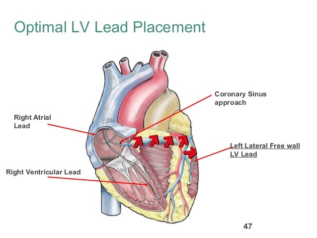 Left Lead Lv Lead Position In Crt | semashow.com