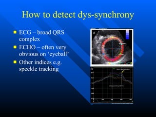How to detect dys-synchrony ECG – broad QRS complex ECHO – often very obvious on ‘eyeball’ Other indices e.g. speckle tracking 