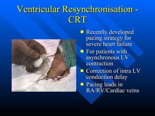 Ventricular Resynchronisation - CRT Recently developed pacing strategy for severe heart failure For patients with asynchronous LV contraction Correction of intra LV conduction delay Pacing leads in RA/RV/Cardiac veins 