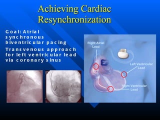 Achieving Cardiac Resynchronization Goal: Atrial synchronous  biventricular pacing Transvenous approach for left ventricular lead via coronary sinus Doug Smith: Right Atrial Lead Right Ventricular Lead Left Ventricular Lead 