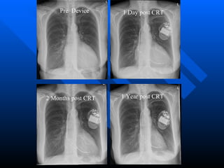 Pre  Device 1 Day post CRT 2 Months post CRT 1 Year post CRT 