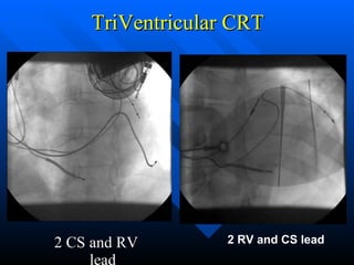 TriVentricular CRT  2 CS and RV lead 2 RV and CS lead 