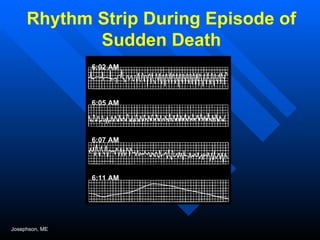 Rhythm Strip During Episode of Sudden Death Josephson, ME 6:02 AM 6:05 AM 6:07 AM 6:11 AM 