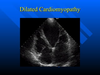 Dilated Cardiomyopathy 