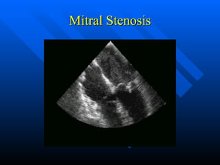 Mitral Stenosis 