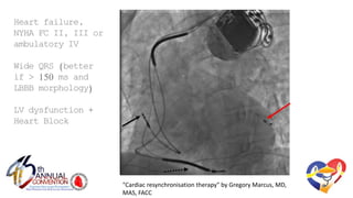 "Cardiac resynchronisation therapy" by Gregory Marcus, MD,
MAS, FACC
Heartfailure,NYHA
FC II,IIIorambulatory
IV
w/Wide QRS (better
if > 150 ms andLBBB
morphology)
----
LV dysfunction+
HeartBlock
 
