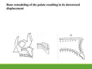 Bone remodeling of the palate resulting in its downward
displacement
 