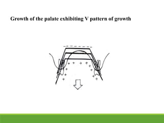 Growth of the palate exhibiting V pattern of growth
 