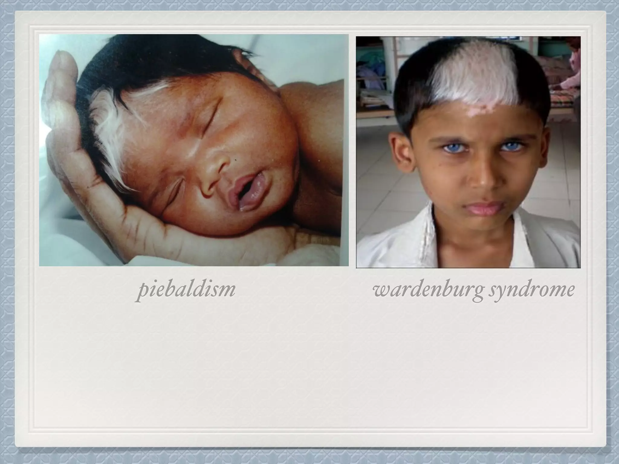 wardenburg syndromepiebaldism
 