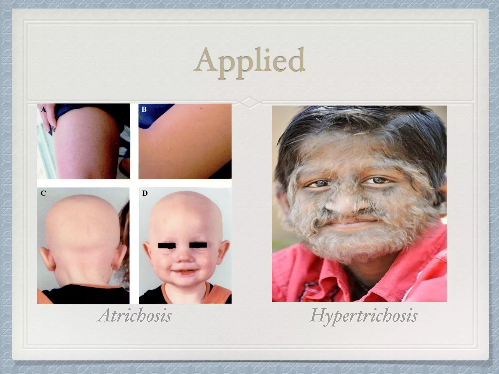 Applied
HypertrichosisAtrichosis
 