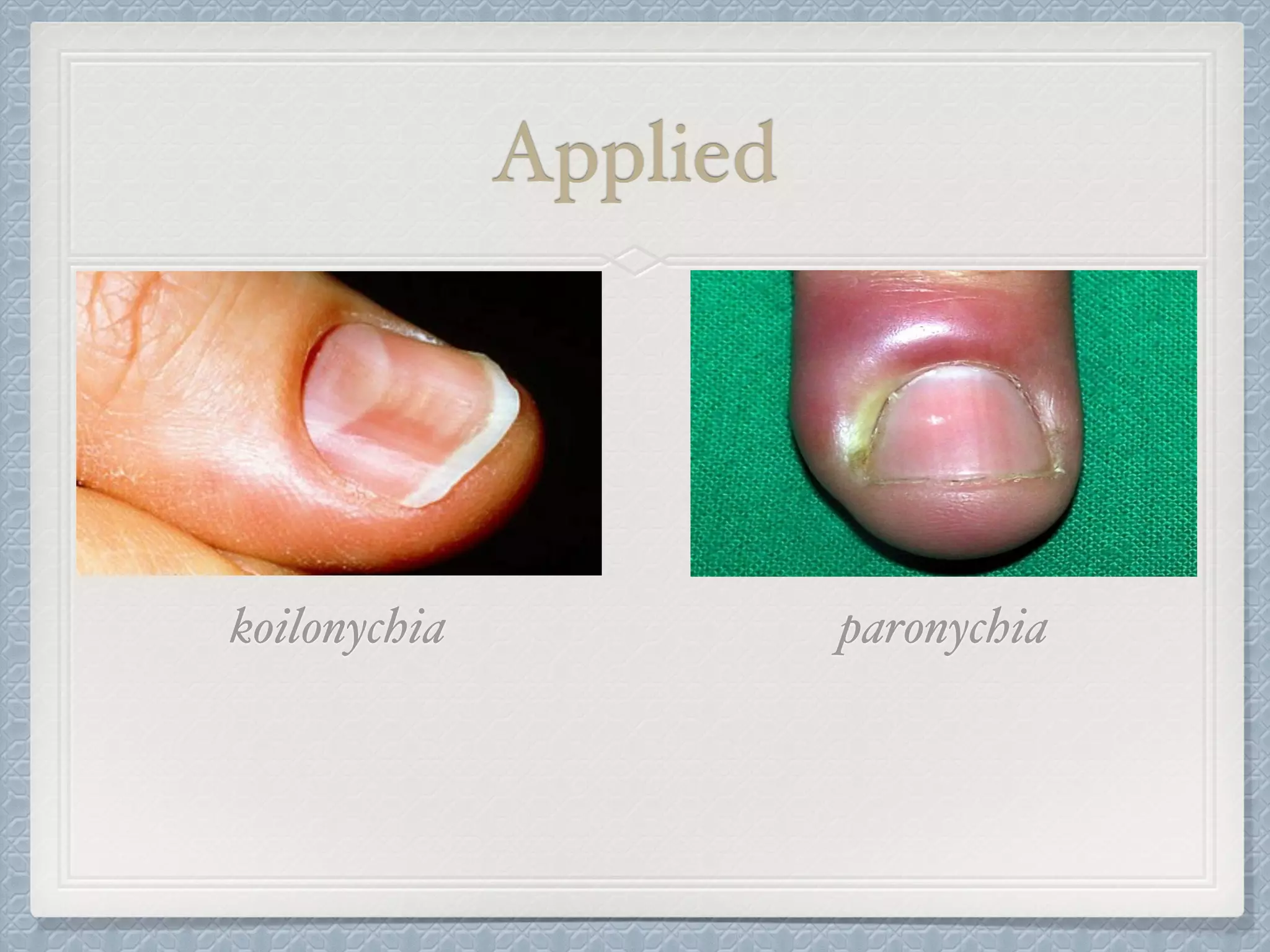 Applied
koilonychia paronychia
 