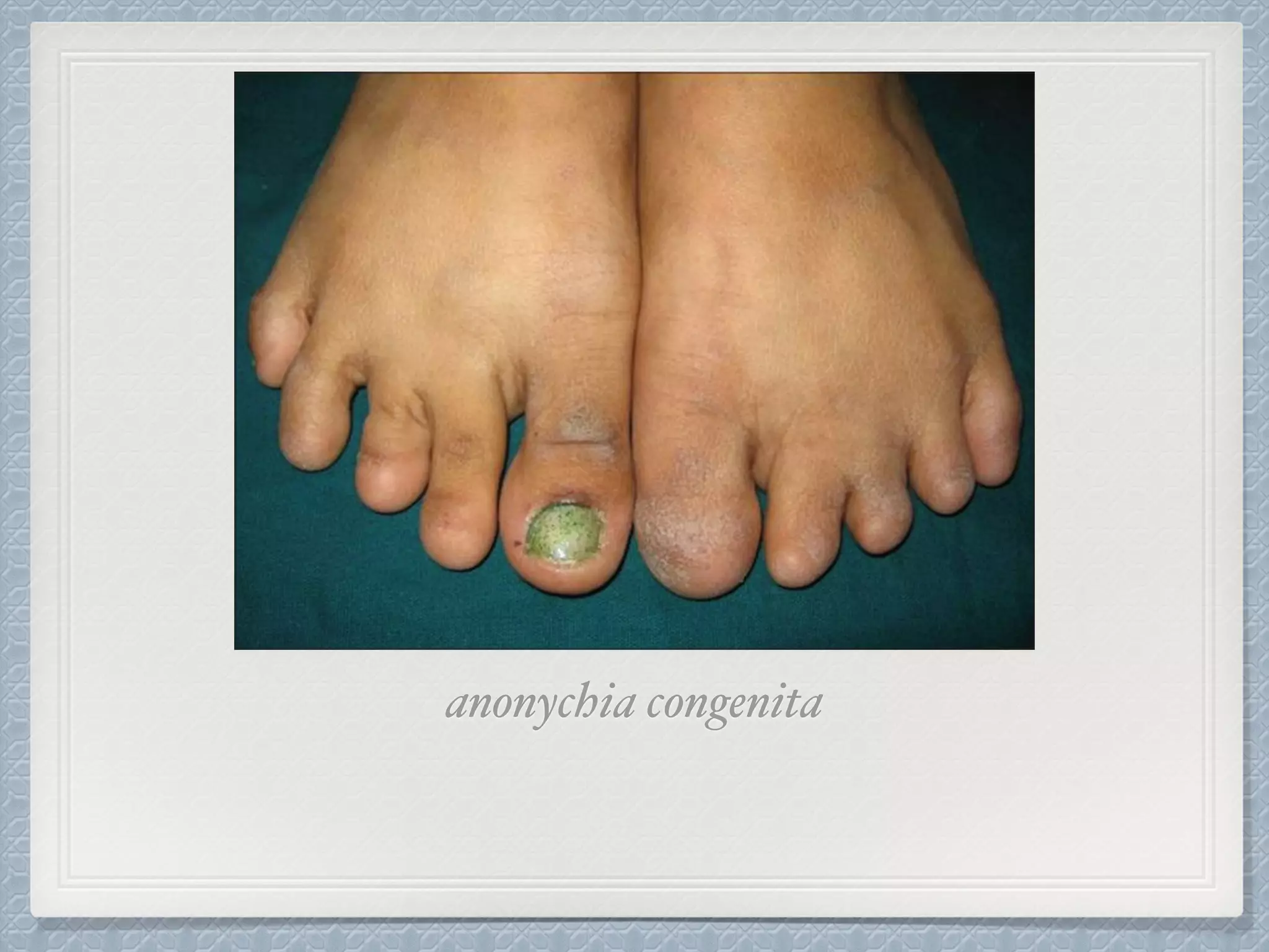 anonychia congenita
 