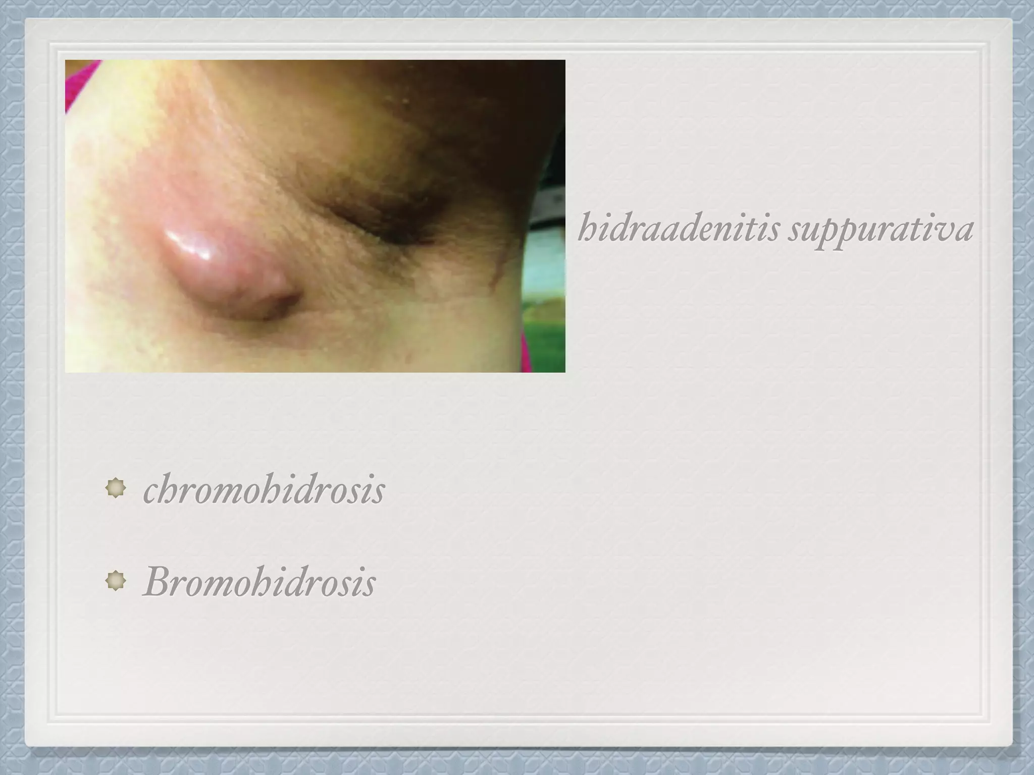 hidraadenitis suppurativa
chromohidrosis
Bromohidrosis
 