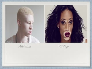 Albinism Vitiligo
 