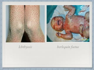 herlequin foetusIchthyosis
 