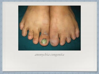anonychia congenita
 