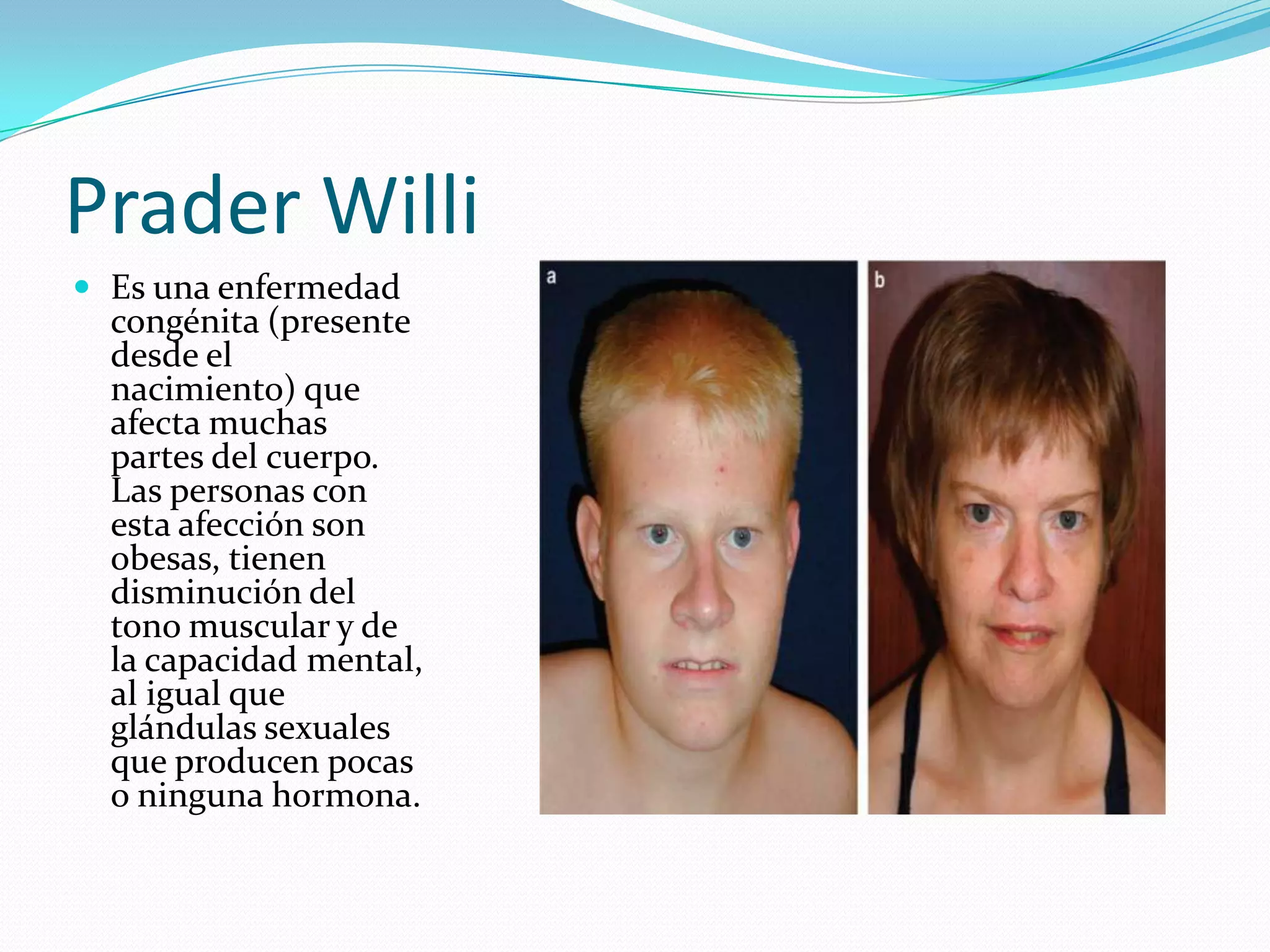 Prader Willi
 Es una enfermedad
congénita (presente
desde el
nacimiento) que
afecta muchas
partes del cuerpo.
Las personas con
esta afección son
obesas, tienen
disminución del
tono muscular y de
la capacidad mental,
al igual que
glándulas sexuales
que producen pocas
o ninguna hormona.
 