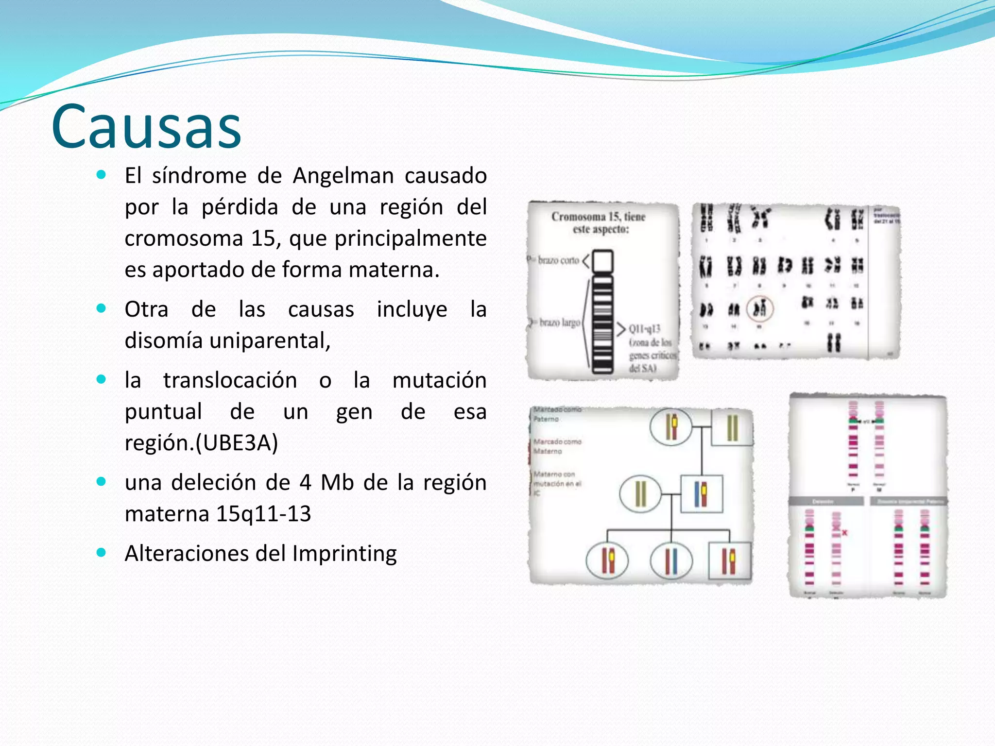 Causas
 El síndrome de Angelman causado
por la pérdida de una región del
cromosoma 15, que principalmente
es aportado de forma materna.
 Otra de las causas incluye la
disomía uniparental,
 la translocación o la mutación
puntual de un gen de esa
región.(UBE3A)
 una deleción de 4 Mb de la región
materna 15q11-13
 Alteraciones del Imprinting
 