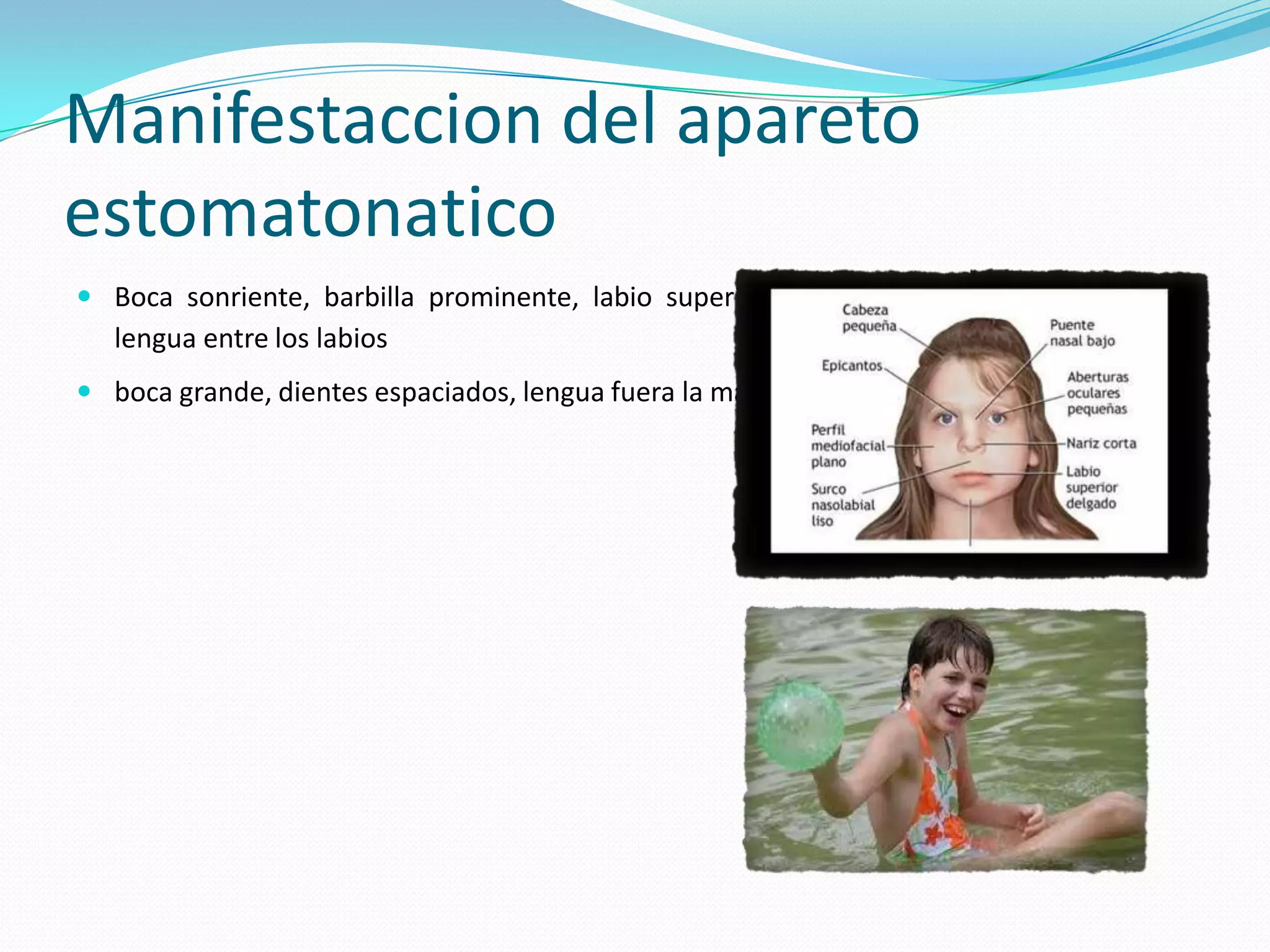 Manifestaccion del apareto
estomatonatico
 Boca sonriente, barbilla prominente, labio superior fino, y tendencia a mantener la
lengua entre los labios
 boca grande, dientes espaciados, lengua fuera la mayor parte del tiempo.
 