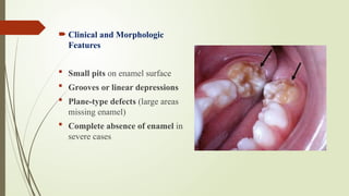 Sharp Linear Defect Tooth Comprehensive Overview of Tooth Development and Dental Anomalies | PPTX