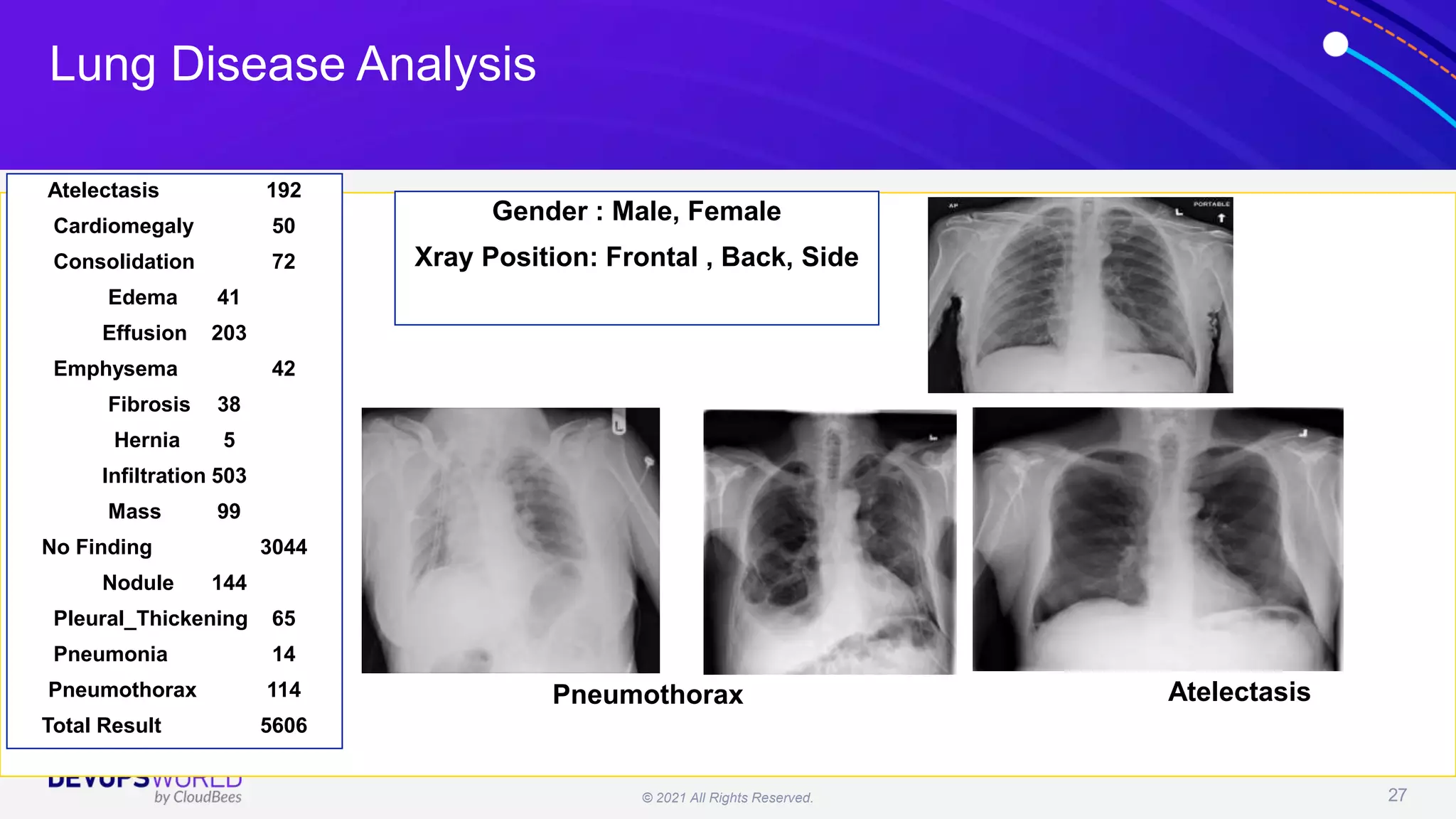 © 2021 All Rights Reserved. 27
Atelectasis 192
Cardiomegaly 50
Consolidation 72
Edema 41
Effusion 203
Emphysema 42
Fibrosis 38
Hernia 5
Infiltration 503
Mass 99
No Finding 3044
Nodule 144
Pleural_Thickening 65
Pneumonia 14
Pneumothorax 114
Total Result 5606
Atelectasis
Pneumothorax
Gender : Male, Female
Xray Position: Frontal , Back, Side
Lung Disease Analysis
 