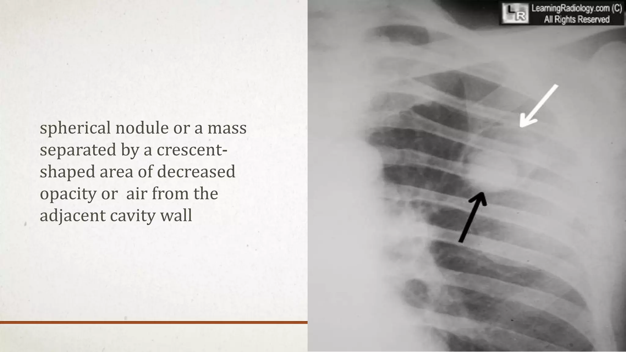 Radiographic manifestations of pulmonary tuberculosis | PPTX