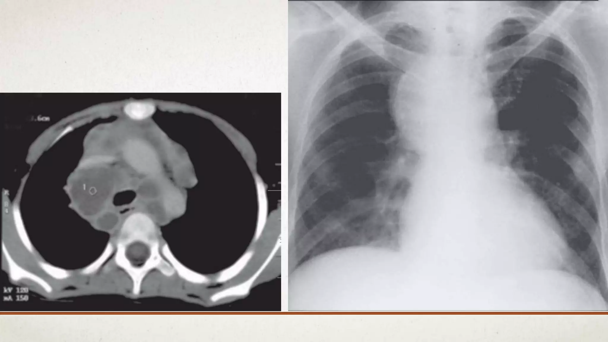 Radiographic manifestations of pulmonary tuberculosis | PPTX