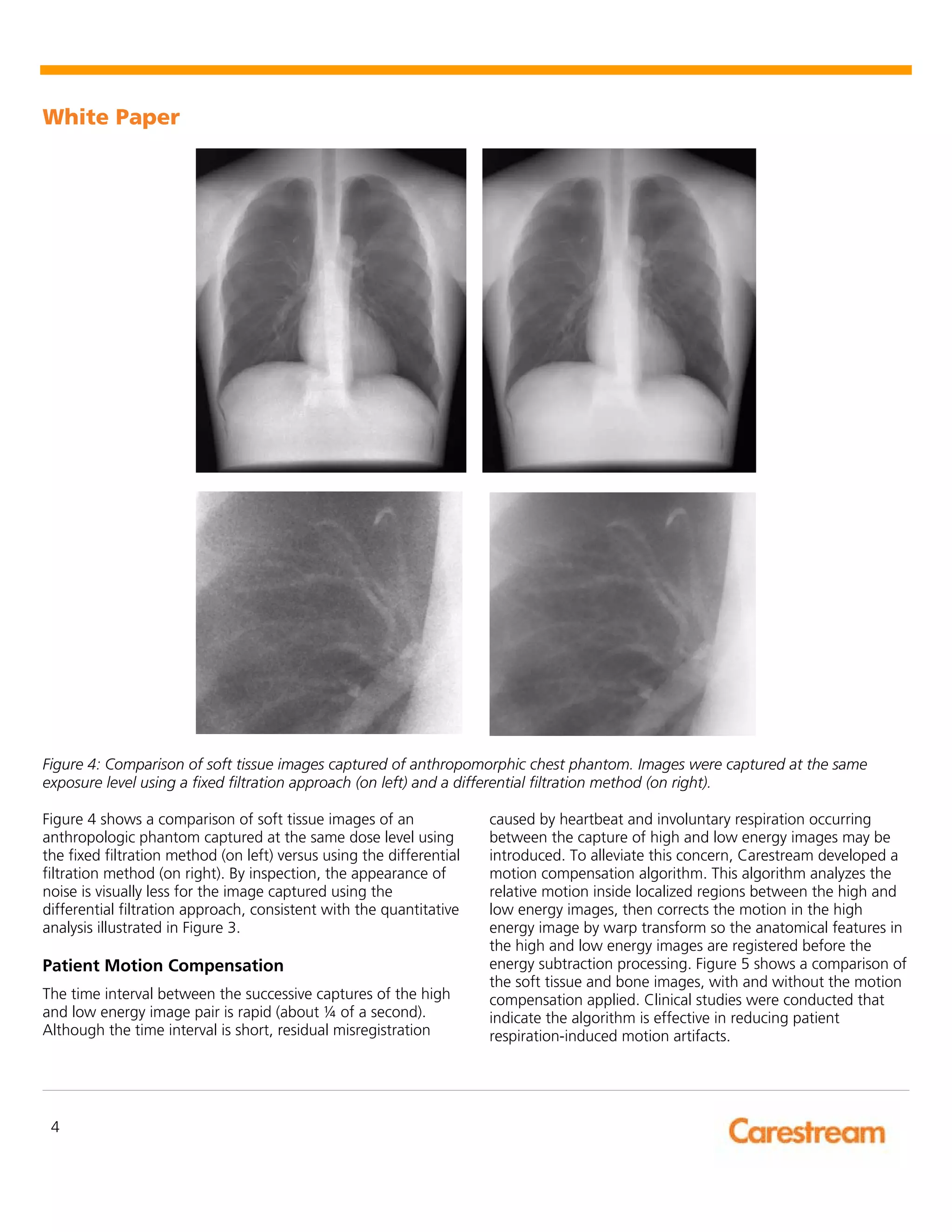 Dose Efficient Dual Energy Subtraction Radiography - Theory of ...