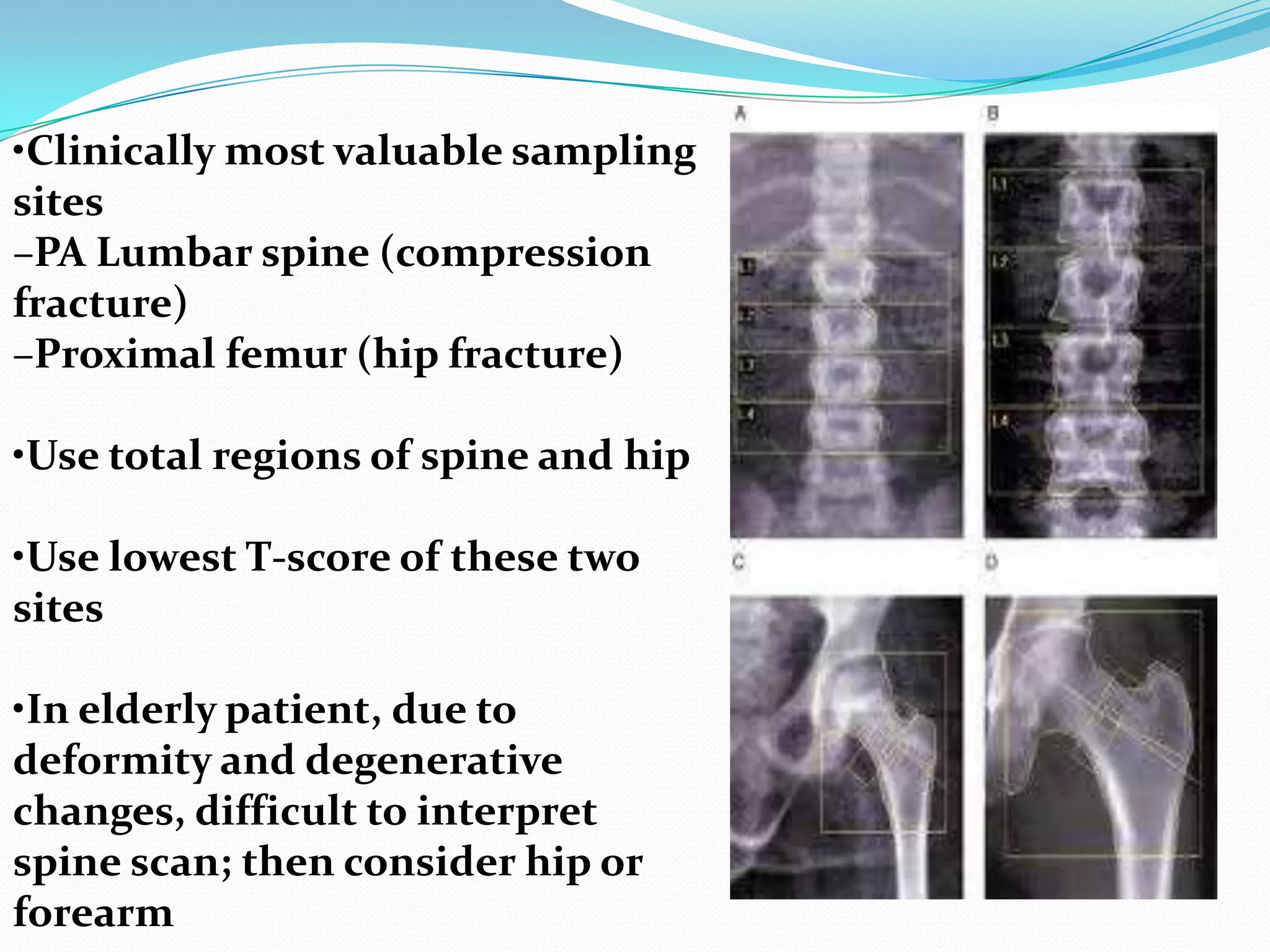 •Clinically most valuable sampling
sites
–PA Lumbar spine (compression
fracture)
–Proximal femur (hip fracture)
•Use total regions of spine and hip

•Use lowest T-score of these two
sites
•In elderly patient, due to
deformity and degenerative
changes, difficult to interpret
spine scan; then consider hip or
forearm

 