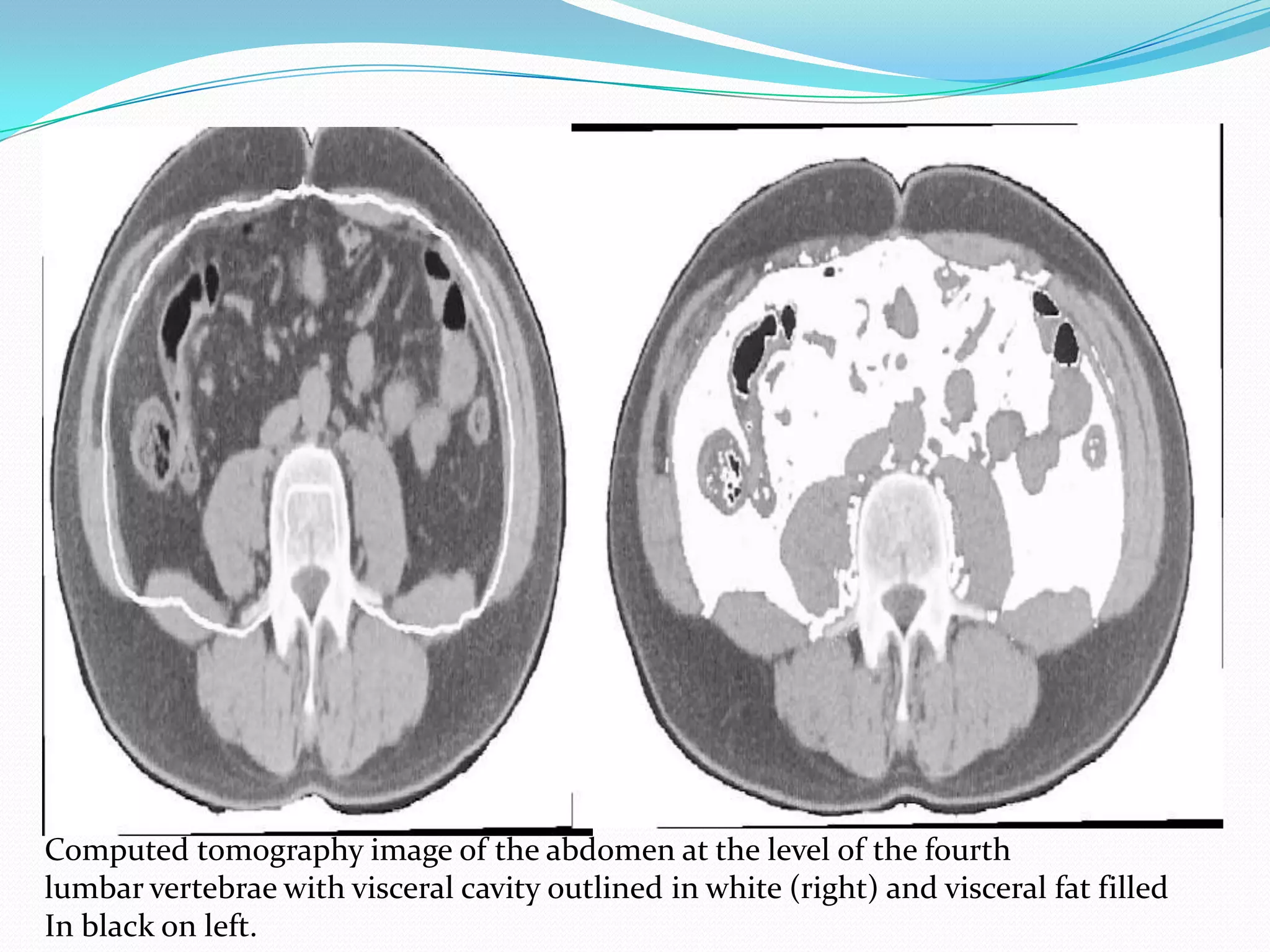 Computed tomography image of the abdomen at the level of the fourth
lumbar vertebrae with visceral cavity outlined in white (right) and visceral fat filled
In black on left.

 