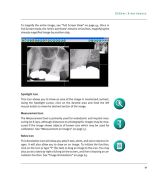 51
DEXray: X-ray Images
To magnify the entire image, see “Full Screen View” on page 44. Once in
Full Screen mode, the ‘bird’s eye frame’ remains in function, magnifying the
already magnified image by another step.
Spotlight Icon
This icon allows you to show an area of the image in maximized contrast.
Using the Spotlight cursor, click on the desired area and hold the left
mouse button to view the desired section of the image.
Measurement Icon
The Measurement tool is primarily used for endodontic and implant mea-
suring on X-rays, although distances on photographic images may be mea-
sured if the image shows objects of known size which may be used for
calibration. See “Measurement on Images” on page 57.
Notes Icon
This Annotation icon will allow you attach text, alerts, and voice notes to im-
ages. It will also allow you to draw on an image. To initiate the function,
click on the icon or type “T” (for text) or drag an image to the icon. You may
also access notes by right-clicking on the screen, and then choosing an an-
notation function. See “Image Annotations” on page 65.
DEXIS_9_EN.book Page 51 Tuesday, October 5, 2010 12:58 PM
 
