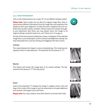 55
DEXray: X-ray Images
4.5.3 Image Enhancement
Click on the Enhancement icon or type “E” to use different display modes.
Please note: These modes do not alter the original image files; they in-
stead extract different information from the image files and emphasize the
display to aid in your diagnosis. A mode that aids in diagnosis for one con-
dition may not with another condition. Please inspect the modes thorough-
ly and experiment with them; you may always return the image to its
original settings using the Home icon, see “Home Icon” on page 52.
The top of the Enhancement dialog box shows a histogram of the selected
image and a curve showing the current contrast and brightness setting. You
may manipulate this curve by clicking and dragging at the two crosses.
Contrast
This mode displays the image in a more contrasted way. This mode was de-
signed to help in cavity detection. The keystroke for this feature is “C”.
Neutral
This feature will restore the image back to its neutral settings. The key-
stroke for this feature is “T” (for take back).
Invert
Invert or the keystroke “I” displays the image in negative mode. Click and
drag in the center of the image or use the arrow keys to change brightness
and contrast. Click again to turn off Invert.
Please note: You may combine Invert with ClearVu and Invert with Color.
DEXIS_9_EN.book Page 55 Tuesday, October 5, 2010 12:58 PM
 