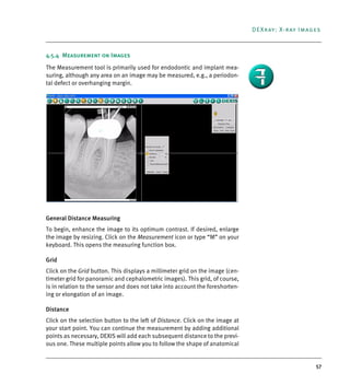 57
DEXray: X-ray Images
4.5.4 Measurement on Images
The Measurement tool is primarily used for endodontic and implant mea-
suring, although any area on an image may be measured, e.g., a periodon-
tal defect or overhanging margin.
General Distance Measuring
To begin, enhance the image to its optimum contrast. If desired, enlarge
the image by resizing. Click on the Measurement icon or type “M” on your
keyboard. This opens the measuring function box.
Grid
Click on the Grid button. This displays a millimeter grid on the image (cen-
timeter grid for panoramic and cephalometric images). This grid, of course,
is in relation to the sensor and does not take into account the foreshorten-
ing or elongation of an image.
Distance
Click on the selection button to the left of Distance. Click on the image at
your start point. You can continue the measurement by adding additional
points as necessary, DEXIS will add each subsequent distance to the previ-
ous one. These multiple points allow you to follow the shape of anatomical
DEXIS_9_EN.book Page 57 Tuesday, October 5, 2010 12:58 PM
 