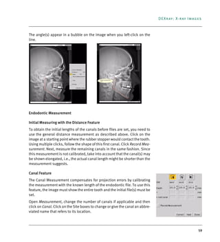59
DEXray: X-ray Images
The angle(s) appear in a bubble on the image when you left-click on the
line.
Endodontic Measurement
Initial Measuring with the Distance Feature
To obtain the initial lengths of the canals before files are set, you need to
use the general distance measurement as described above. Click on the
image at a starting point where the rubber stopper would contact the tooth.
Using multiple clicks, follow the shape of this first canal. Click Record Mea-
surement. Next, measure the remaining canals in the same fashion. Since
this measurement is not calibrated, take into account that the canal(s) may
be shown elongated, i.e., the actual canal length might be shorter than the
measurement suggests.
Canal Feature
The Canal Measurement compensates for projection errors by calibrating
the measurement with the known length of the endodontic file. To use this
feature, the image must show the entire tooth and the initial file(s) must be
set.
Open Measurement, change the number of canals if applicable and then
click on Canal. Click on the Site boxes to change or give the canal an abbre-
viated name that refers to its location.
DEXIS_9_EN.book Page 59 Tuesday, October 5, 2010 12:58 PM
 