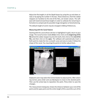 Chapter 4
60
Adjust the file lengths in all the Depth boxes by using the up and down ar-
rows or by typing the number in the box. These distances, from the rubber
stoppers (or handles) to the end of the files, are known values. The soft-
ware will need to know these lengths in order to calibrate the remaining in-
formation to compensate for possible image elongation or foreshortening.
The default length of 20mm may be changed in DEXray Preferences.
Measuring with the Canal Feature
Starting with the canal whose site box is highlighted in gold, return to your
image. The Canal function needs three clicks: Click on the beginning of the
file where the rubber stopper touches the tooth, then click on the end of the
file, and then click on the apex. The software will automatically insert a
forth point to make the line a smooth curve and also to make it follow the
shape of the canal. You may drag the points to further adjust them.
Keyboard users may select the Correct button to adjust points. After select-
ing Correct, press Enter and use Backspace to move to the desired point.
Then use the arrow keys to reposition the point. Press Enter to save the
changes.
The measurement dialog box shows the distance between your end-of-file
point and the apex point and the entire length of this canal (the sum of the
DEXIS_9_EN.book Page 60 Tuesday, October 5, 2010 12:58 PM
 