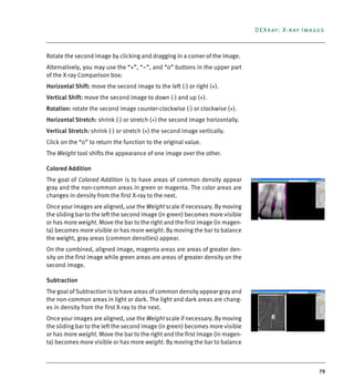 79
DEXray: X-ray Images
Rotate the second image by clicking and dragging in a corner of the image.
Alternatively, you may use the “+”, “–”, and “0” buttons in the upper part
of the X-ray Comparison box:
Horizontal Shift: move the second image to the left (-) or right (+).
Vertical Shift: move the second image to down (-) and up (+).
Rotation: rotate the second image counter-clockwise (-) or clockwise (+).
Horizontal Stretch: shrink (-) or stretch (+) the second image horizontally.
Vertical Stretch: shrink (-) or stretch (+) the second image vertically.
Click on the “0” to return the function to the original value.
The Weight tool shifts the appearance of one image over the other.
Colored Addition
The goal of Colored Addition is to have areas of common density appear
gray and the non-common areas in green or magenta. The color areas are
changes in density from the first X-ray to the next.
Once your images are aligned, use the Weight scale if necessary. By moving
the sliding bar to the left the second image (in green) becomes more visible
or has more weight. Move the bar to the right and the first image (in magen-
ta) becomes more visible or has more weight. By moving the bar to balance
the weight, gray areas (common densities) appear.
On the combined, aligned image, magenta areas are areas of greater den-
sity on the first image while green areas are areas of greater density on the
second image.
Subtraction
The goal of Subtraction is to have areas of common density appear gray and
the non-common areas in light or dark. The light and dark areas are chang-
es in density from the first X-ray to the next.
Once your images are aligned, use the Weight scale if necessary. By moving
the sliding bar to the left the second image (in green) becomes more visible
or has more weight. Move the bar to the right and the first image (in magen-
ta) becomes more visible or has more weight. By moving the bar to balance
DEXIS_9_EN.book Page 79 Tuesday, October 5, 2010 12:58 PM
 