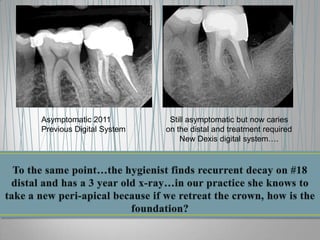 Asymptomatic 2011
Previous Digital System

Still asymptomatic but now caries
on the distal and treatment required
New Dexis digital system….

 