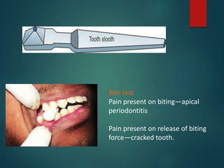 Bite test
Pain present on biting—apical
periodontitis
Pain present on release of biting
force—cracked tooth.
 