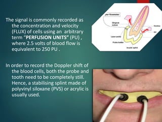 The signal is commonly recorded as
the concentration and velocity
(FLUX) of cells using an arbitrary
term “PERFUSION UNITS” (PU) ,
where 2.5 volts of blood flow is
equivalent to 250 PU .
In order to record the Doppler shift of
the blood cells, both the probe and
tooth need to be completely still.
Hence, a stabilising splint made of
polyvinyl siloxane (PVS) or acrylic is
usually used.
 
