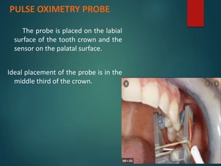 The probe is placed on the labial
surface of the tooth crown and the
sensor on the palatal surface.
Ideal placement of the probe is in the
middle third of the crown.
PULSE OXIMETRY PROBE
 